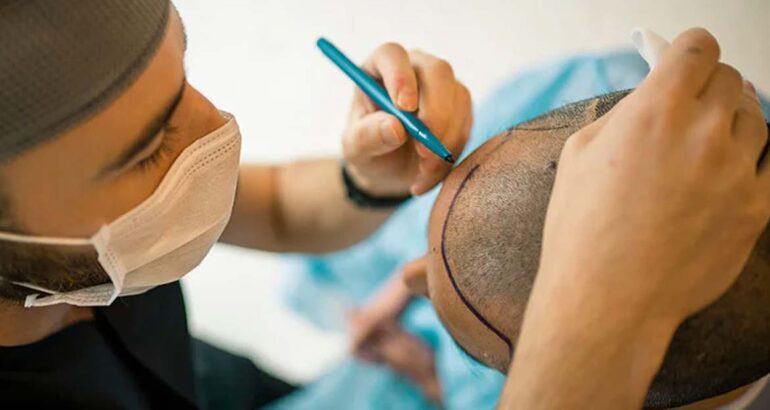 Virginscalp Hair Transplant